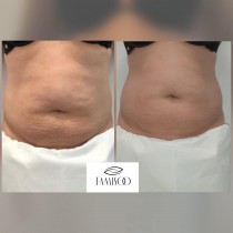 LIPOSONIX - tratament slabire, Sector 3 - Bucuresti